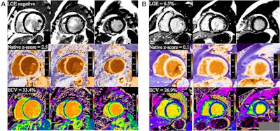 Cardiac MRI predicts risk of death in dilated cardiomyopathy