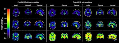 Neuroinflammation persists for 2 years in long COVID