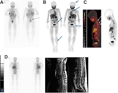 PET tracer shows promise in patients with neuroblastoma