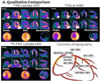 AI boosts cardiac PET imaging