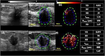 qHDMI differentiates radial scars from invasive breast cancer