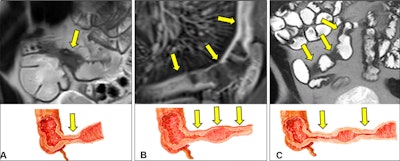 MRI, CT, ultrasound biomarkers help identify Crohn disease strictures