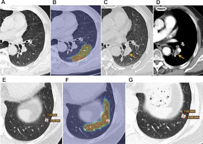 Consider global lung features on LDCT to improve cancer risk prediction