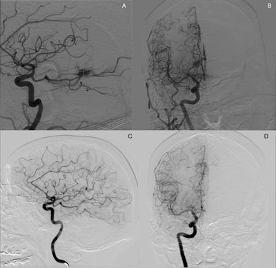 What’s the best treatment for ‘eloquent’ brain AVMs?