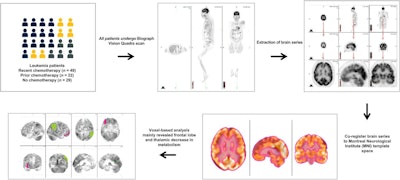 PET/CT reveals ‘chemo brain’ regions in leukemia patients