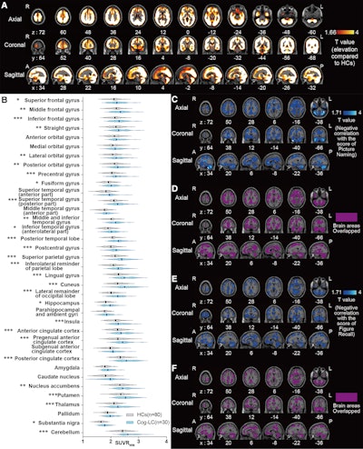 PET reveals mechanism underlying brain fog in long COVID