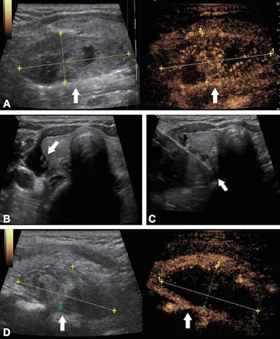Ablation procedures cure thyroid disorders in older patients
