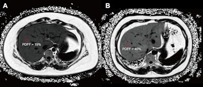 MRI predicts diabetes in obese patients
