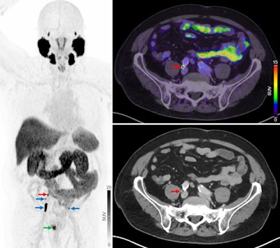 PSMA-PET/CT may replace NaF-PET/CT in advanced prostate cancer