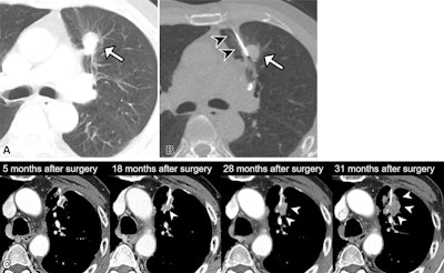 Lung biopsy before surgery linked to cancer recurrence