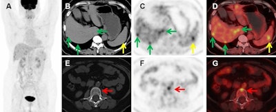 FDG-PET/CT detects metastatic eye tumors