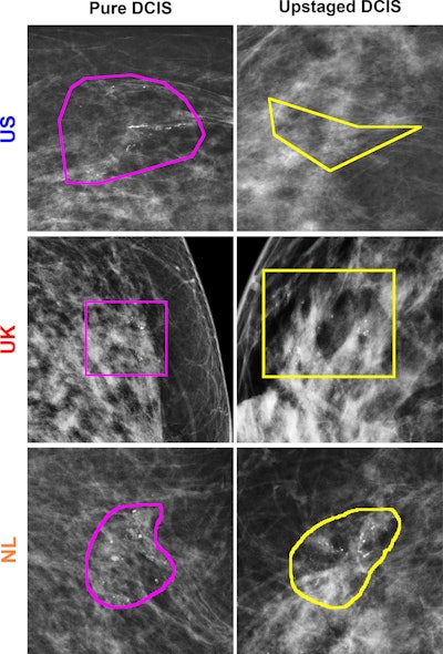 Mammography-based radiomic models predict DCIS upstaging