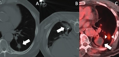 Salvage image-guided thermal ablation treats lung cancer after SBRT