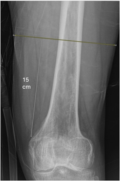 X-rays predict mortality following hip fracture surgery