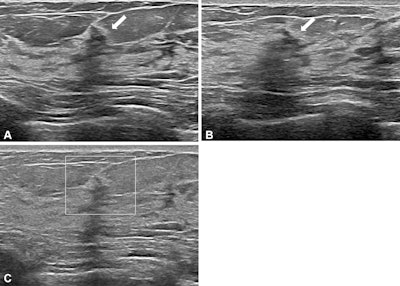 Radiologists can designate nonmass lesions on breast ultrasound
