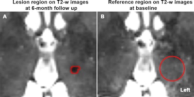 T1/T2-weighted MRgFUS ratio imaging improves brain lesion contrast