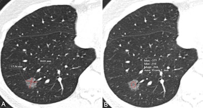 CT-based model assesses lung lesions from nonsolid nodules