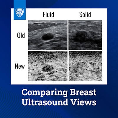 New breast ultrasound approach cuts false positives by nearly a third