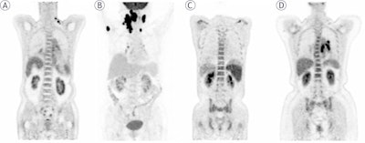 PET/CT detects bone involvement in patients with lymphoma