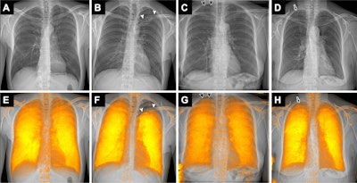 Dark-field radiography improves detection of pneumothorax