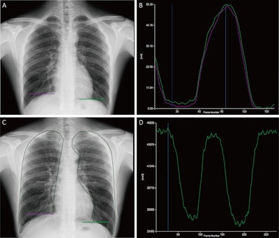 Dynamic chest radiography effective for diagnosing COPD
