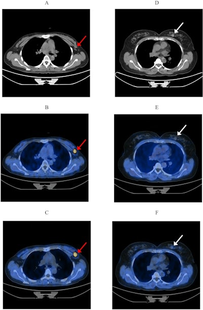 Early PET/CT feasible in women with suspected breast cancer