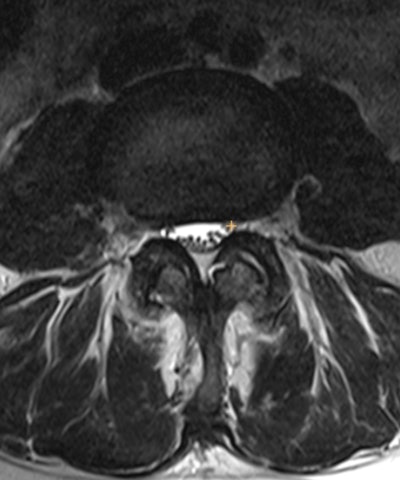 RSNA releases Lumbar Degenerative Imaging Spine Classification dataset