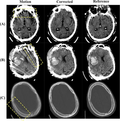 Diffusion motion correction boosts portable brain CT image quality