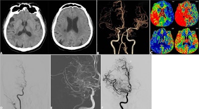 Adding endovascular recanalization does not improve sNAIAO treatment