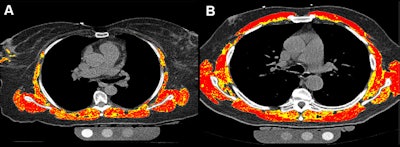 AI-measured myosteatosis from CAC CT scans helps predict future COPD