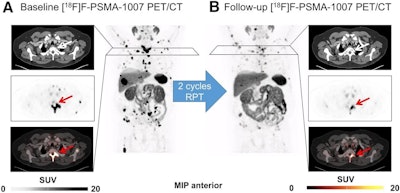 PSMA-PET predicts patient responses to Ac-225-based RPT