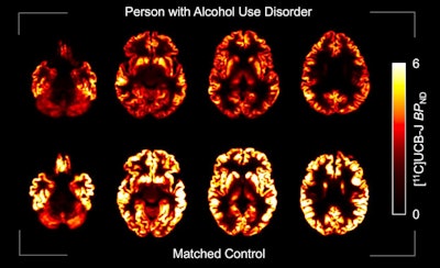 How does high alcohol use affect the brain?