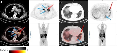 Theranostic pair ready for testing in lung cancer