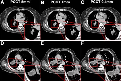 PCCT has higher safety profile that EID-CT for lung imaging