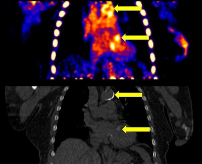 PET/CT visualizes complications in patients on hemodialysis