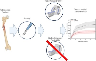 Study questions routine use of radiotherapy after bone surgery