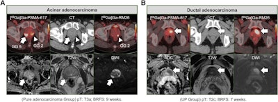PSMA-PET/CT best for staging prostate cancer