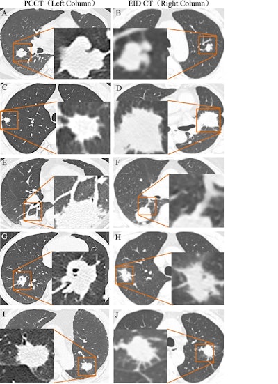 ‘Quadruple low’ PCCT protocol improves lung cancer imaging