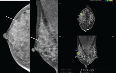 Could AI scoring help with managing DCIS?