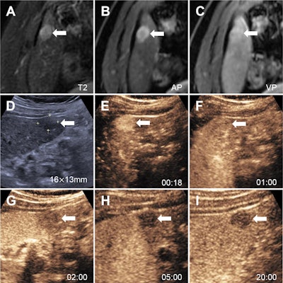 CEUS with perfluorobutane diagnoses small-cell HCC