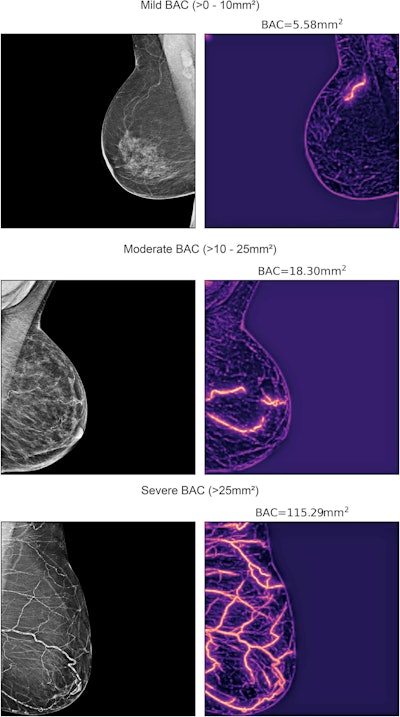 AI-calculated BAC on mammograms predicts cardiovascular disease in women