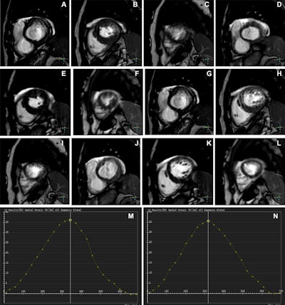 Novel AI-enhanced MRI algorithm helps assess left ventricular function