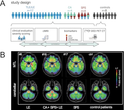 PET reveals disease activity in autoimmune encephalitis