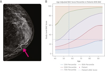 AI model predicts cardiovascular risk from BACs on mammograms