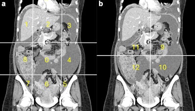 CT-based nomogram aids in managing advanced ovarian cancer