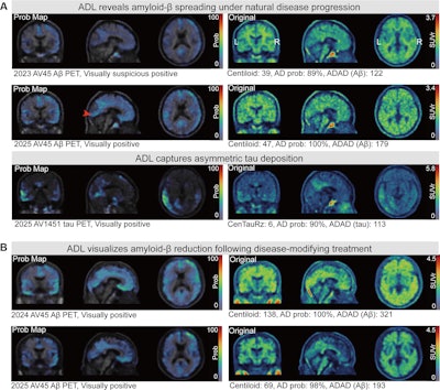 New method decouples Alzheimer’s disease pathology at PET