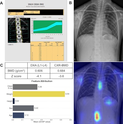 AI estimates children’s bone density on chest x-rays