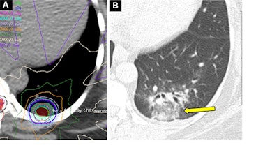 How best to characterize CT lung findings after radiation therapy
