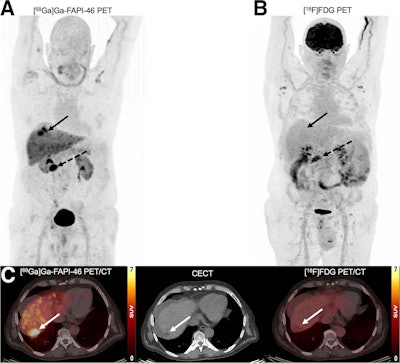 FAPI-PET superior to FDG-PET in liver cancer
