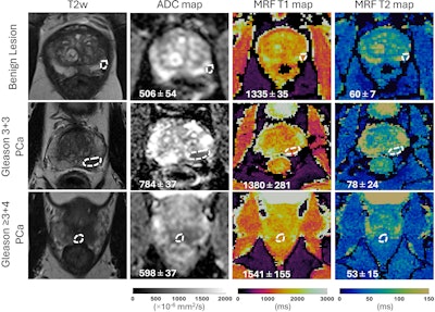 MRI ‘fingerprinting’ technique characterizes prostate lesions